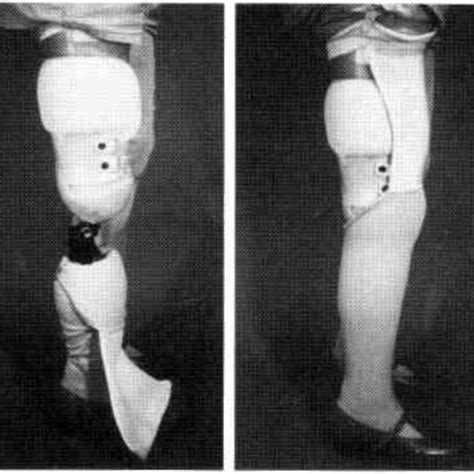 Pdf Function After Through Knee Compared With Below Knee And Above
