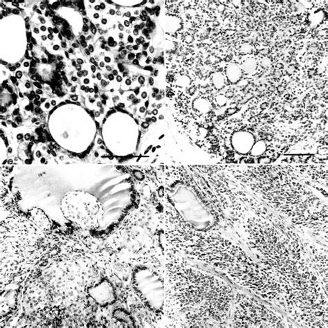 Parafollicular C Cell Hyperplasia Parafollicular Cells Show Marked