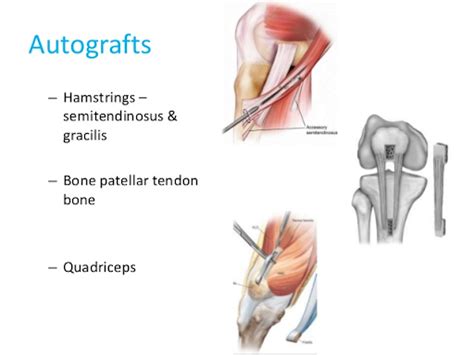 Acl Graft Options Choosing The Graft That Works Best For You — Best