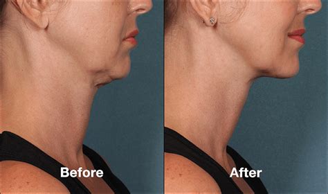 Jowl Fat Removal With Kybella Beverly Hills Los Angeles West