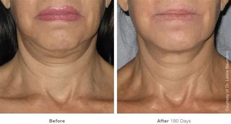 Double Chin Removal Sagging Neck Dr Haus Dermatology