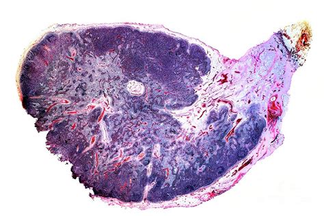 Lymph Gland Photograph By Dr Keith Wheelerscience Photo Library Fine