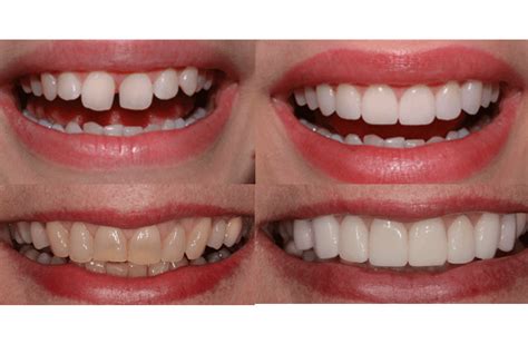 Dental Veneers In Detail Alux Dental