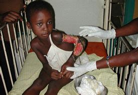 Hantavirus pulmonary syndrome (hps) is one of two potentially fatal syndromes of zoonotic origin caused by species of hantavirus. Searching for causes of Buruli ulcers in Ghana - Fogarty ...