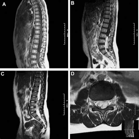 Primary Malignant Peripheral Nerve Sheath Tumor Of The Cauda Equina In