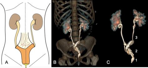 Urinary Diversion After Pelvic Exenteration For Gynecologic