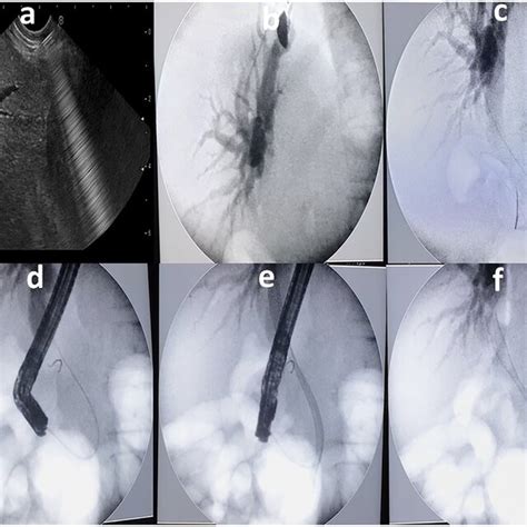 A Eus Guided Puncture Of Intrahepatic Duct B Contrast Injection