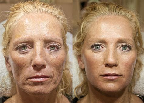 Botox Lower Face Before And After