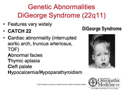 Digeorge Syndrome What Is It Symptoms Diagnosis Treat Vrogue Co