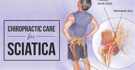 Chiropractic Care For Sciatica