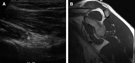 Clinical Outcomes After Decompression Of The Nerve To The Teres Minor