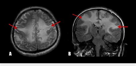 Magnetic Resonance Imaging Of The Brain At The Time Of Diagnosis A Download Scientific