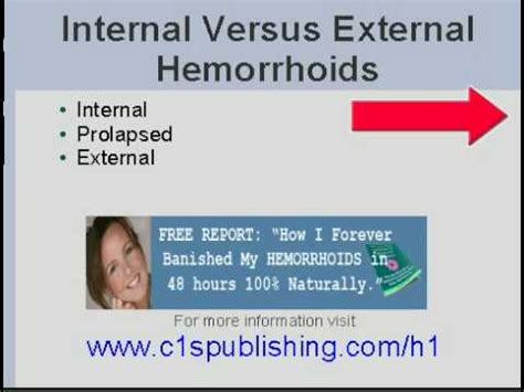 Brand explains that difference between internal and external hemorrhoids. Difference Between Internal Hemorrhoids Versus External ...