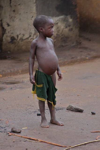 Ugandan Boy With Distended Belly Flickr Photo Sharing