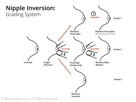 Inverted Nipple Correction Archives The Private Clinic