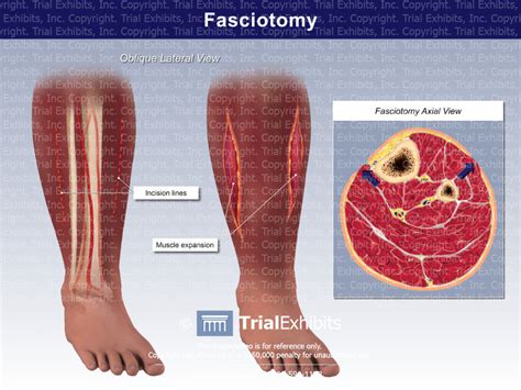 Fasciotomy Trial Exhibits Inc