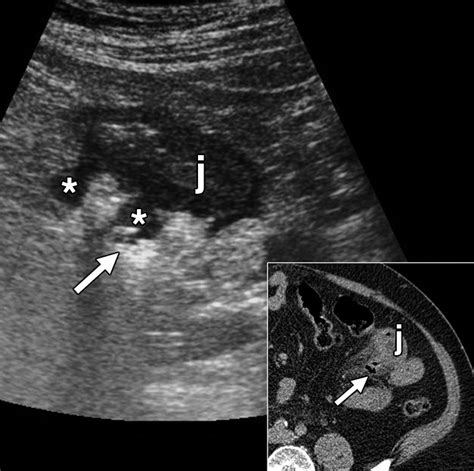 Sonography Of Small Bowel Perforation Ajr