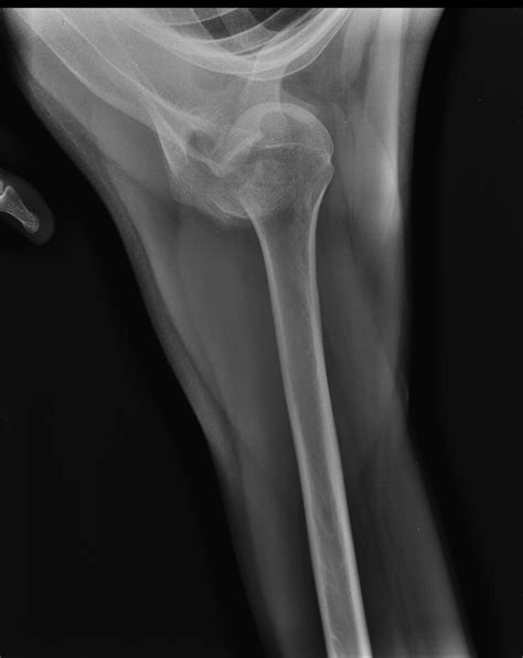 Shoulder Dislocation X Ray