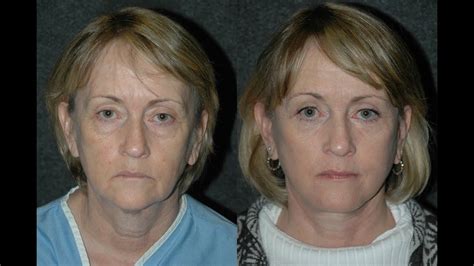 Facelift Surgery Before And After And Eyelid Lift On 60 Year Old Woman