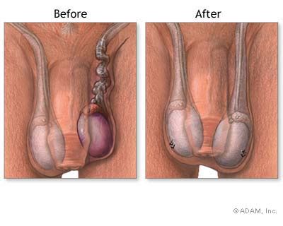 The New York Times Health Slide Show Testicular Torsion Repair