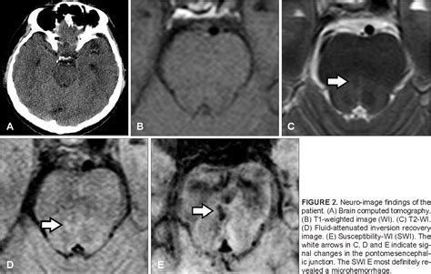 Figure 2 From A Case Of Traumatic Unilateral Internuclear
