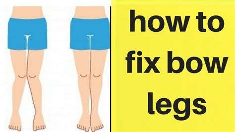 How To Fix Bow Legs Bow Legs No More Youtube