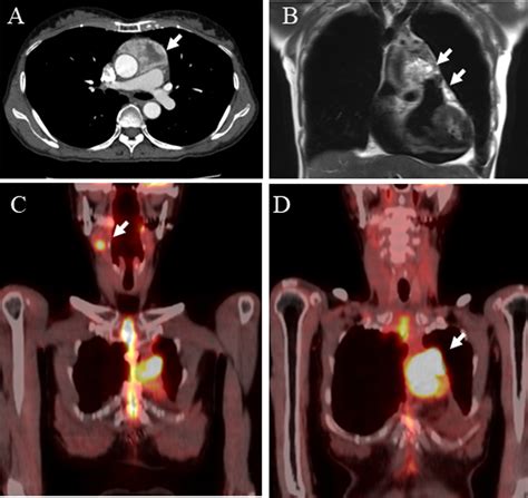 Paraganglioma Of The Carotid Body And Intrapericardium Journal Of