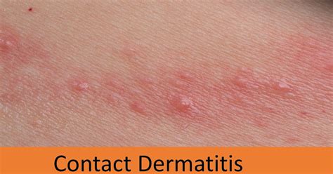 Contact Dermatitis Signssymptomstreatmentdermatologic Disorder