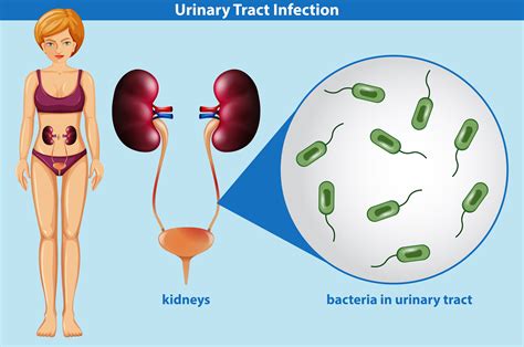 Human Anatomy Of Urinary Tract Infection 302613 Vector Art At Vecteezy