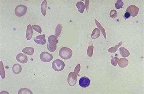 Sickle Cell Anemia Under Microscope Blisset Kishaba99
