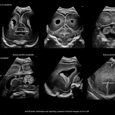 Technique And Reporting Posterior Fontanel Images At 24 Weeks Ga