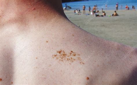 Skin Pigmentation After Sunburn Stock Image C0106371 Science