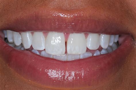 What Is Diastema A Diastema Case Study From Southview Dentistry
