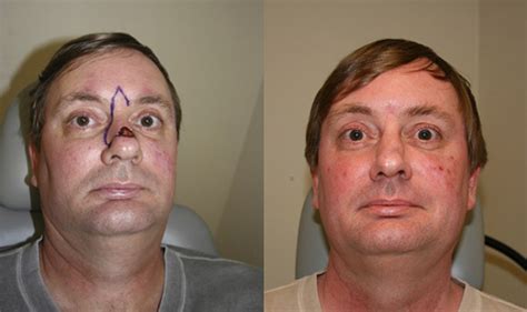 Nasal Skin Cancer Reconstruction