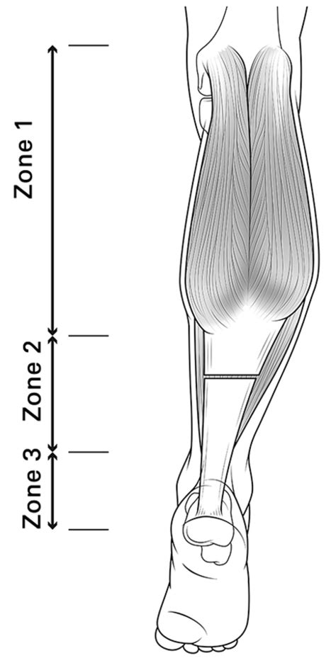 The Transverse Vulpius Gastrocsoleus Recession For Equinus Gait In