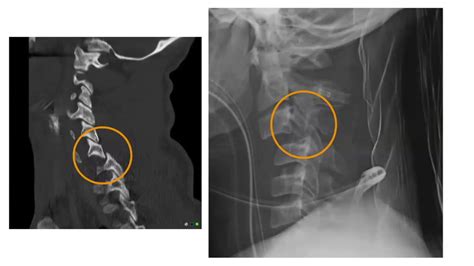 Dr Fonteneaux Overview Unstable C Spine Fractures Youtube