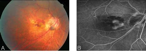 Figure 1 From Retinal Detachment With Macular Hole Following Combined