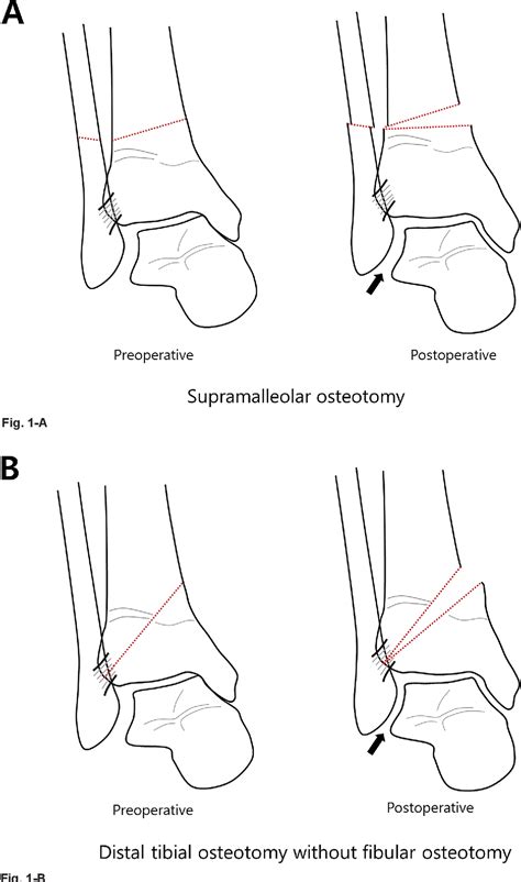 Figure 1 From Distal Tibial Osteotomy Without Fibular Osteotomy For