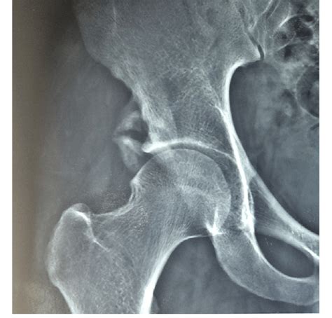 Pelvic Avulsion Fracture Radiology