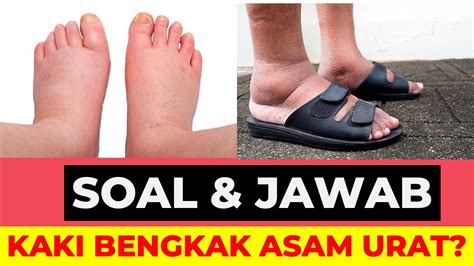 Dok Apa Penyebab Kaki Bengkak Dan Apa Karena Asam Urat Soal And Jawab