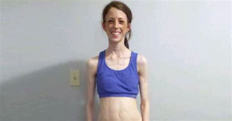 severely anorexic woman s life saved by worried gym goers staging an intervention irish mirror