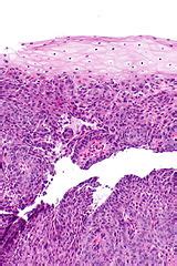 Squamous Cell Carcinoma Of The Esophagus Libre Pathology