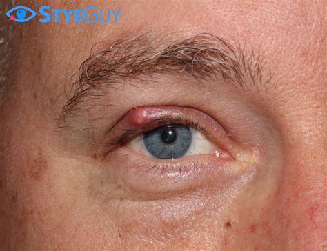 Stye Photos Eyelid Lesion Eyelid Skin Cancer The Styeguy