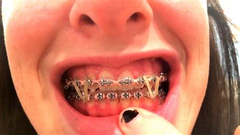 Braces With Power Chains And Elastics Dental Braces Braces Rubber