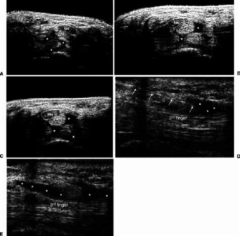 A Axial Ultrasound Us Image Of The Carpal Tunnel Isolated