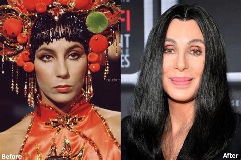 Cher Plastic Surgery Procedures Details And Before After Photos