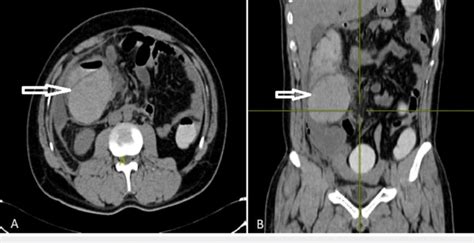 Contrast Enhanced Computed Tomography Cect Abdomen With Oral And
