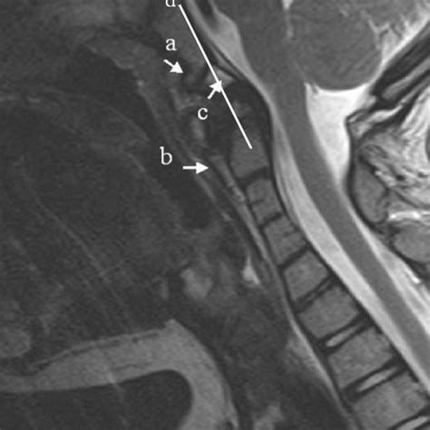 Sagittal Mri Imaging Revealing Discontinuity Of The Cervical Ligaments