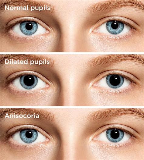 Pupils Dilated Symptoms And Treatments All About Vision