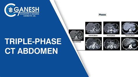 Triple Phase Ct Abdomen Ganesh Diagnostic Youtube